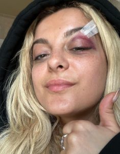 Bebe Rexha injured